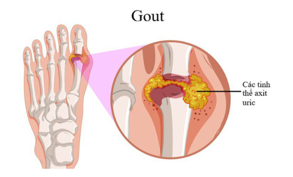 TẢO XOẮN SPIRULINA VÀ BỆNH GOUT